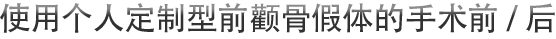 使用个人定制型前颧骨假体的手术前/后