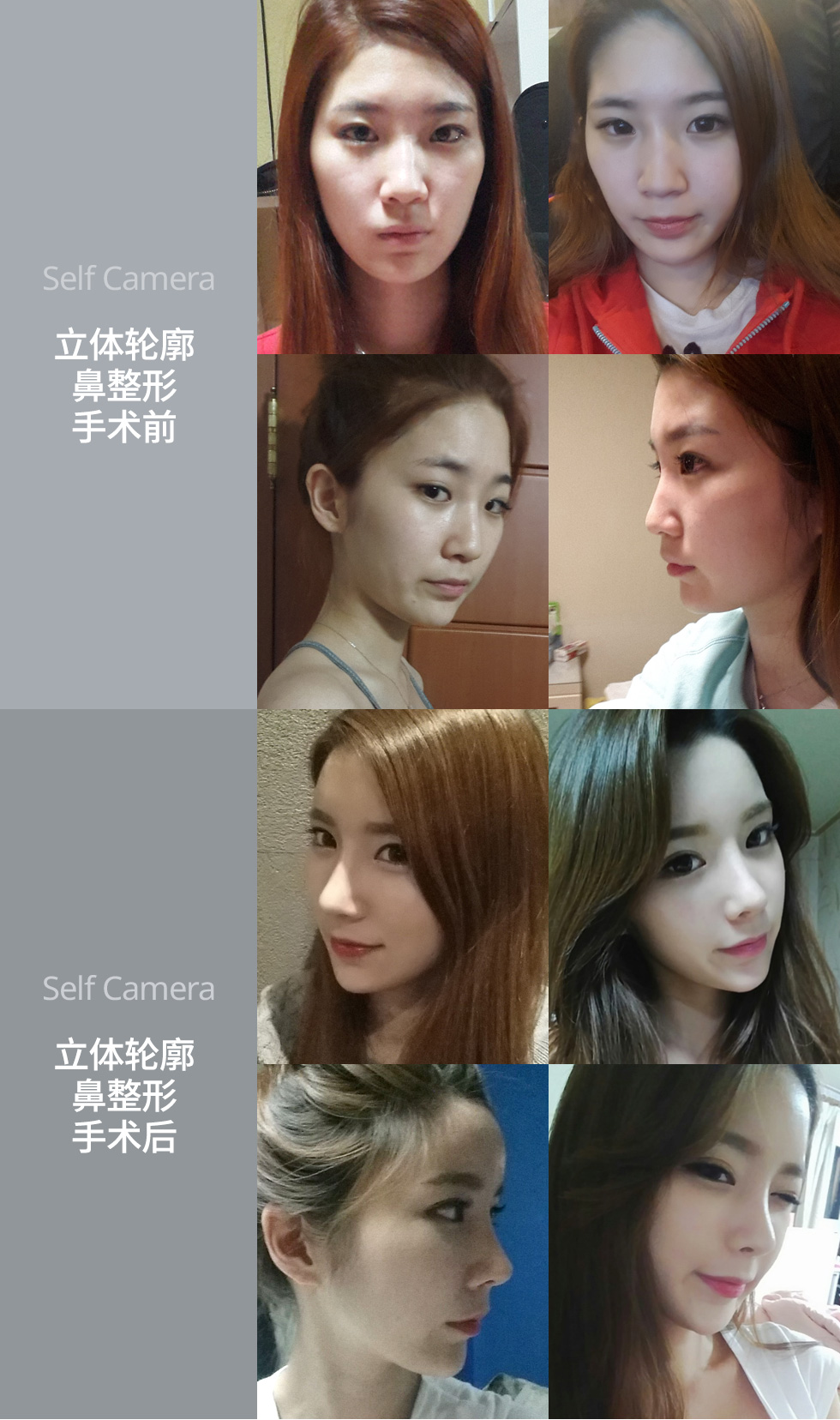 树立面部的中心 立体轮廓鼻整形手术