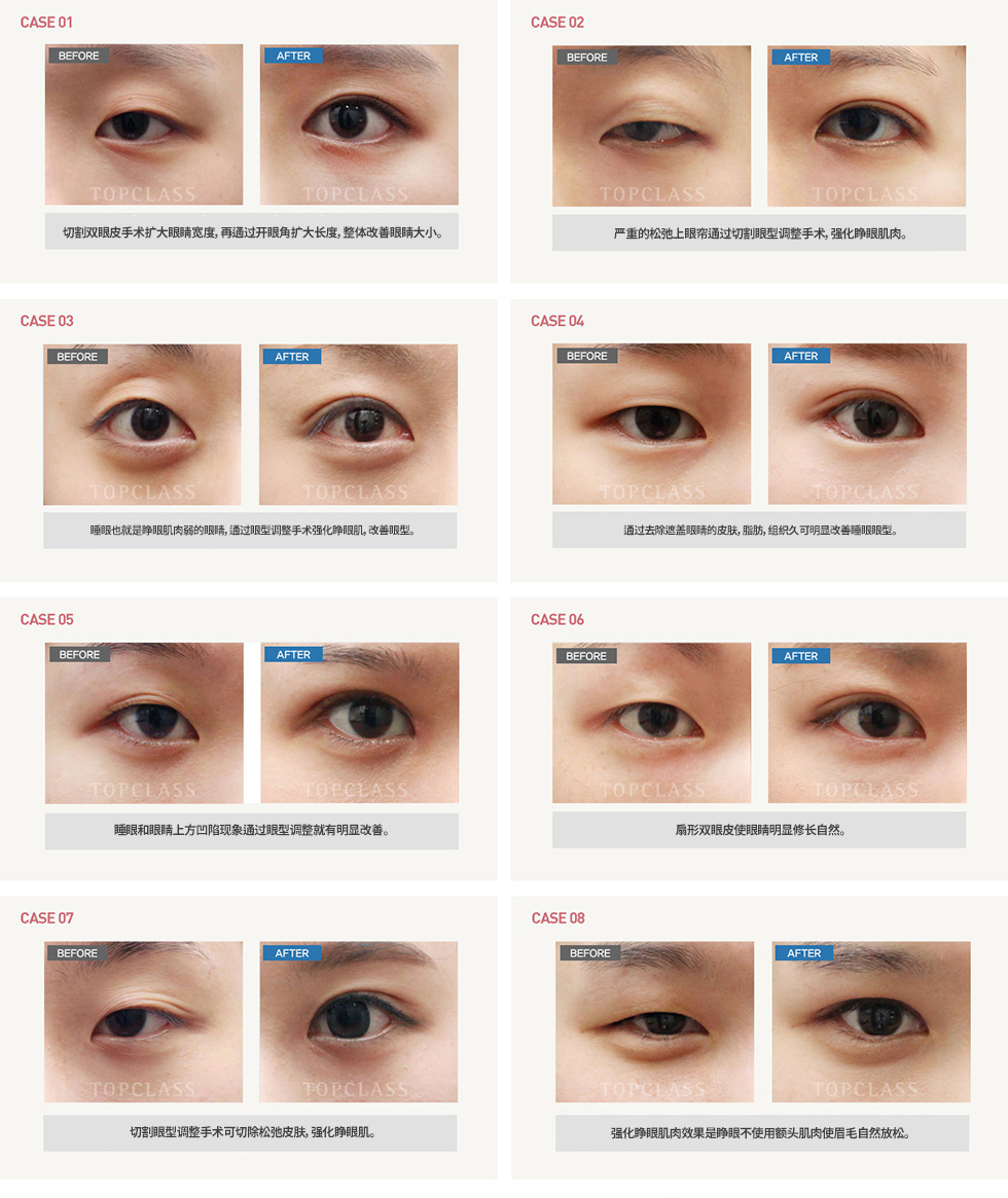 切开法眼型矫正术手术前/后