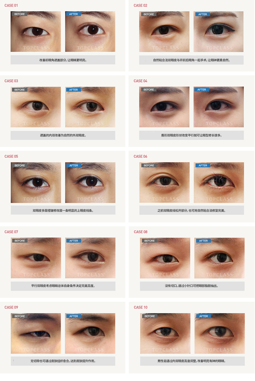 自然流畅法双眼皮手术前/后