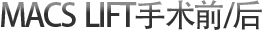 MACS  LIFT手术前/后