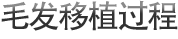 毛发移植过程