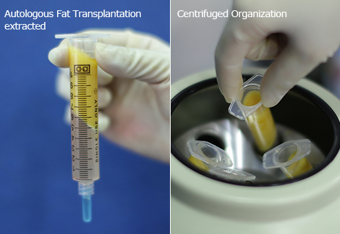 自体脂肪提取与精练脂肪, 圆心分离机
