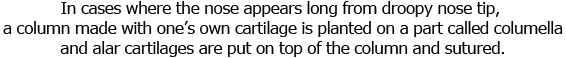 In cases where the nose appears long from droopy nose tip, a column made with one’s own cartilage is planted on a part called biju and wing cartilages are put on top of the column and sutured.