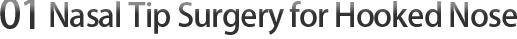 01 Nose Tip Surgery for Hooked Nose