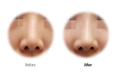 Case13 Before and After