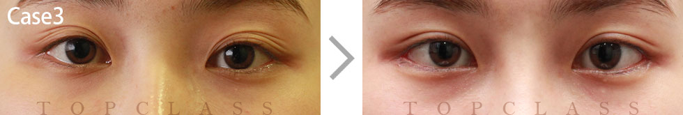 Case3 Multi Outer Corner Extension（Lateral Canthoplasty）Before/After
