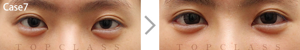 Case7 Multi Outer Corner Extension（Lateral Canthoplasty）Before/After

