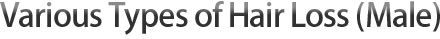 各类型脱发种类（男性）